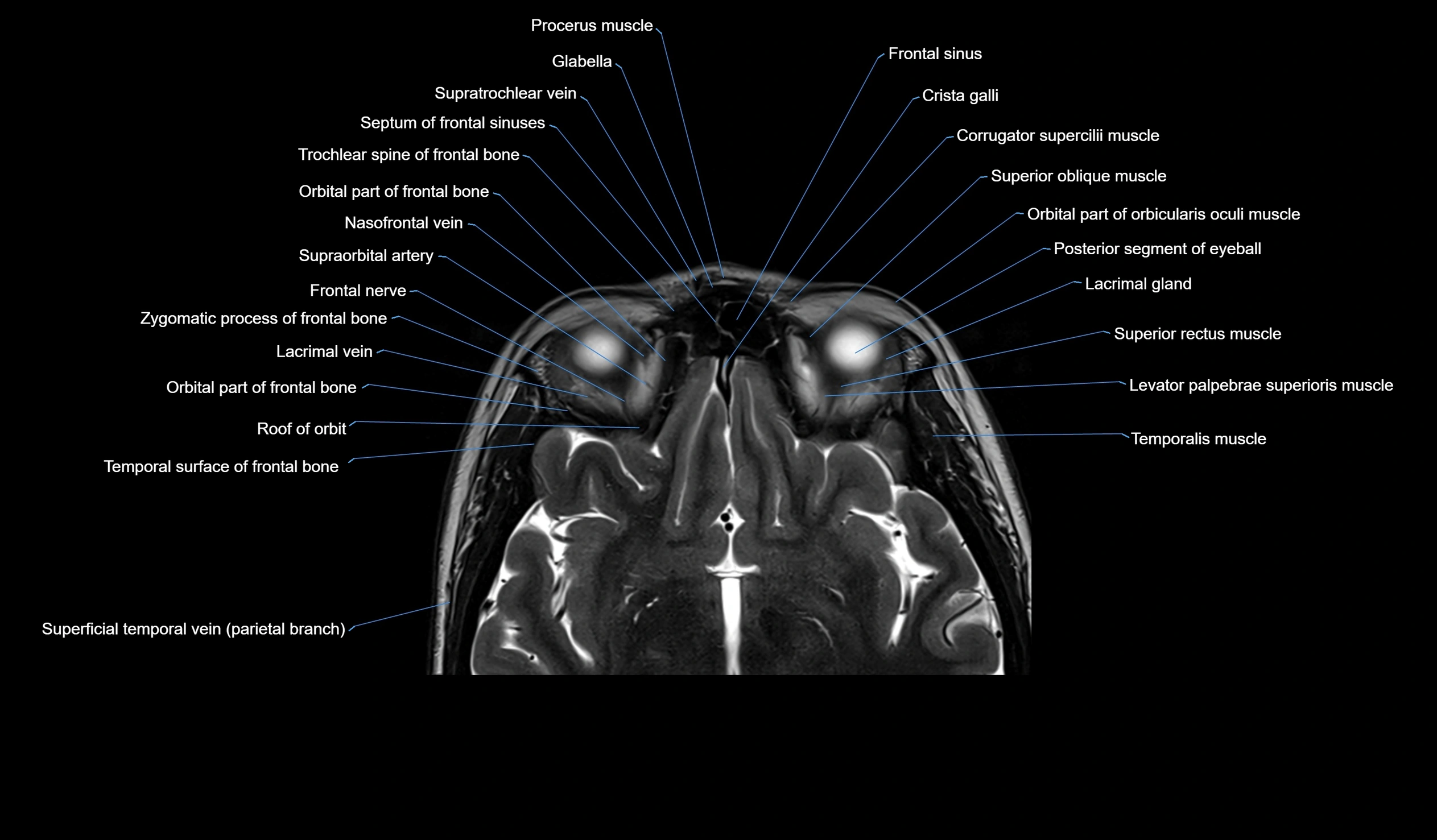 MRI face & paranasal sinuses(PNS) labelled  axial  cross sectional anatomy 3T radiology  image -00026.webp